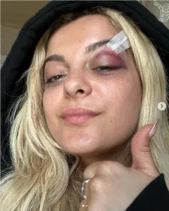   Bebe Rexha efter att hon blivit träffad av en mobiltelefon