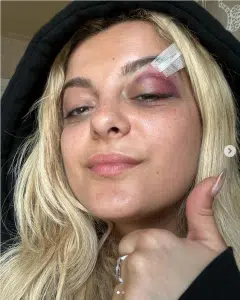   Bebe Rexha, efter hun blev ramt af en mobiltelefon